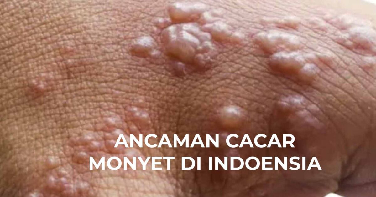 Antisipasi Penyebaran Cacar Monyet