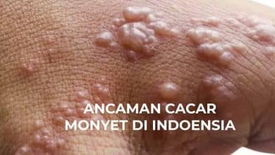 Antisipasi Penyebaran Cacar Monyet