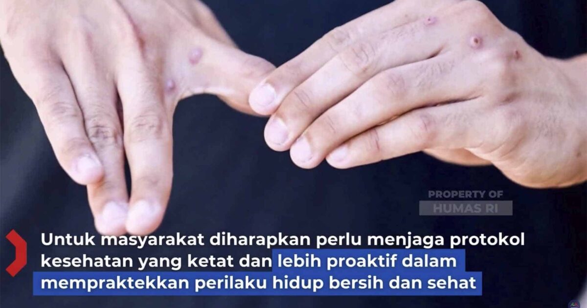 Cacar Monyet Pertama di Indonesia