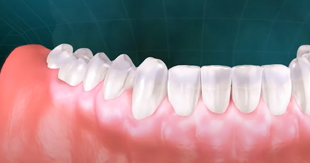 Tips Mencegah dan Mengobati Gusi Bengkak